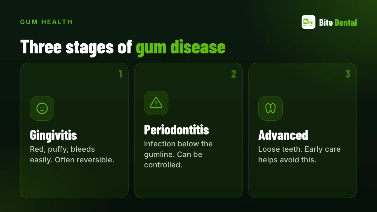 Three stages of gum disease: gingivitis, periodontitis, advanced periodontitis