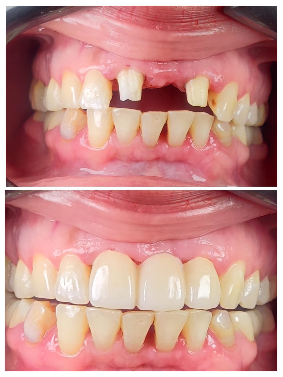 Before and after 3-unit zirconia bridge at Bite Dental Clinic
