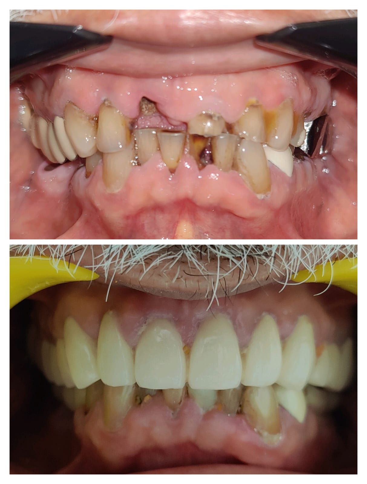 Full mouth rehabilitation zirconia crowns complex case