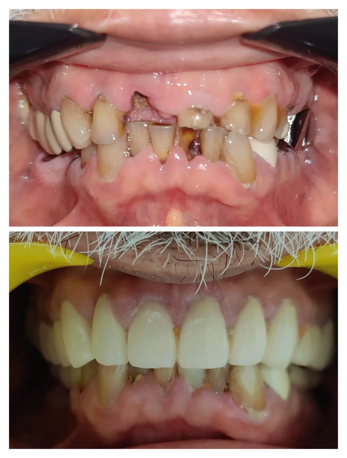 Full mouth rehabilitation zirconia crowns complex case