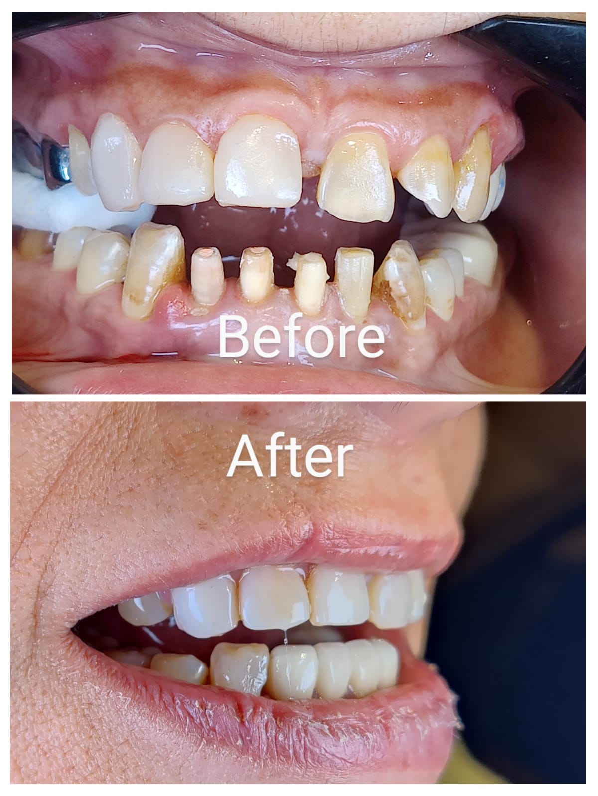 Lower anterior zirconia crowns for spacing and wear