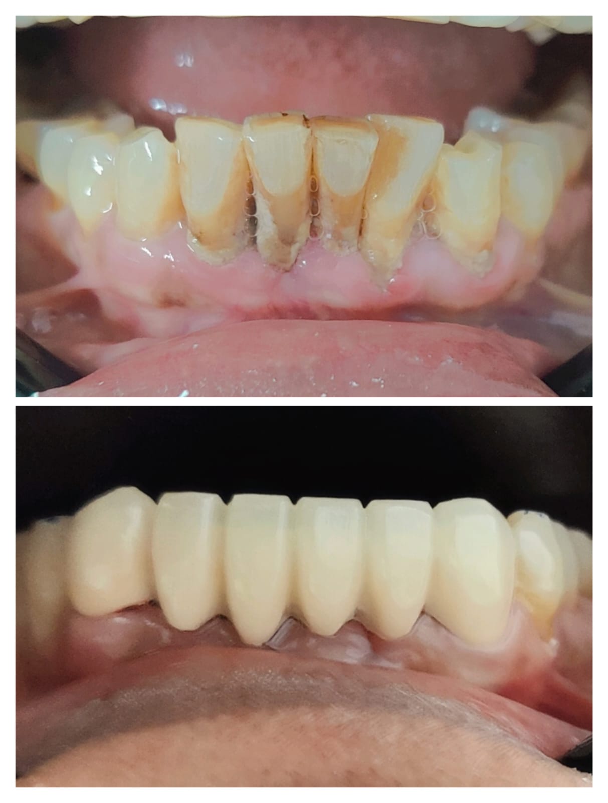Lower anterior crown rehabilitation for discolouration
