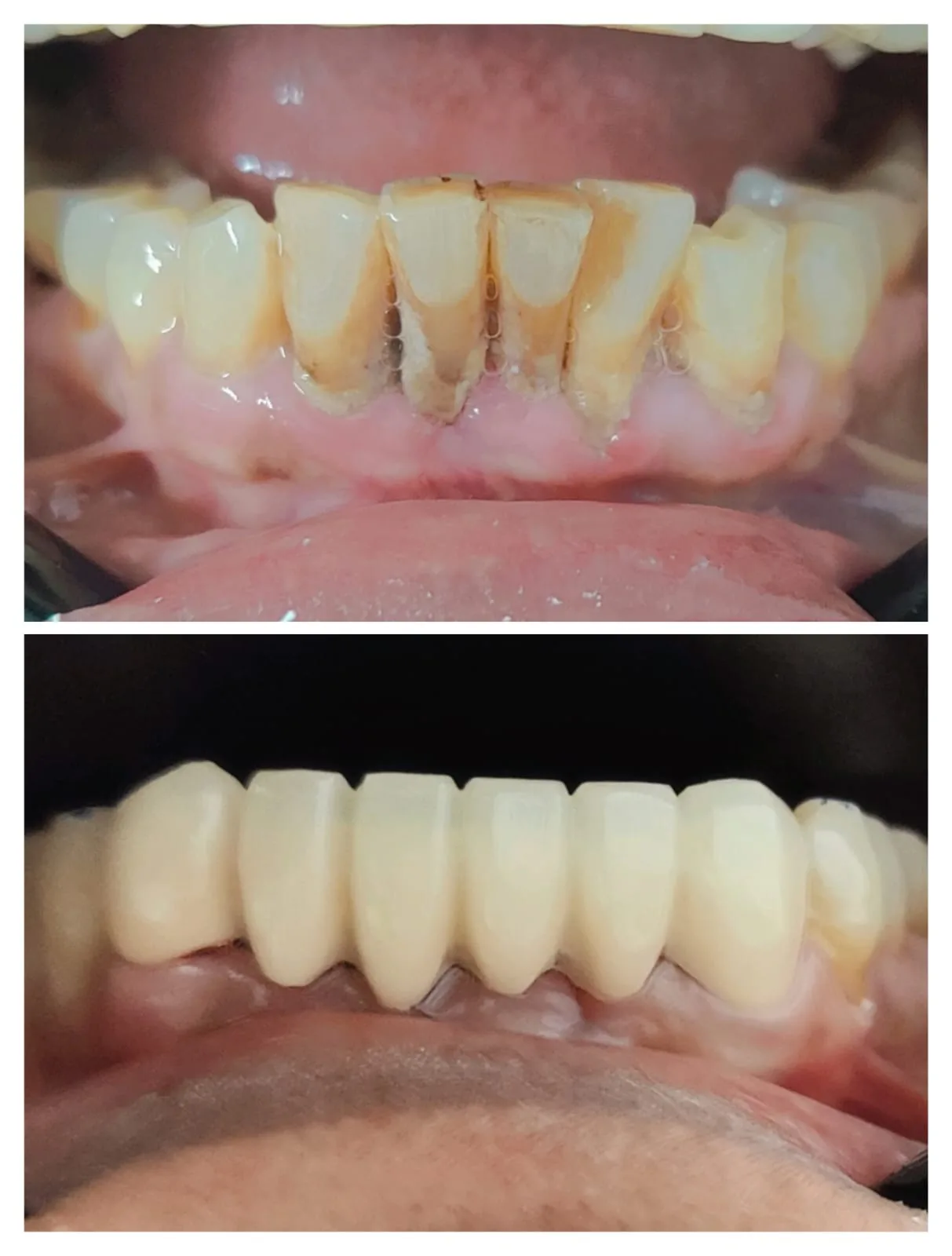 Lower anterior crown rehabilitation for discolouration