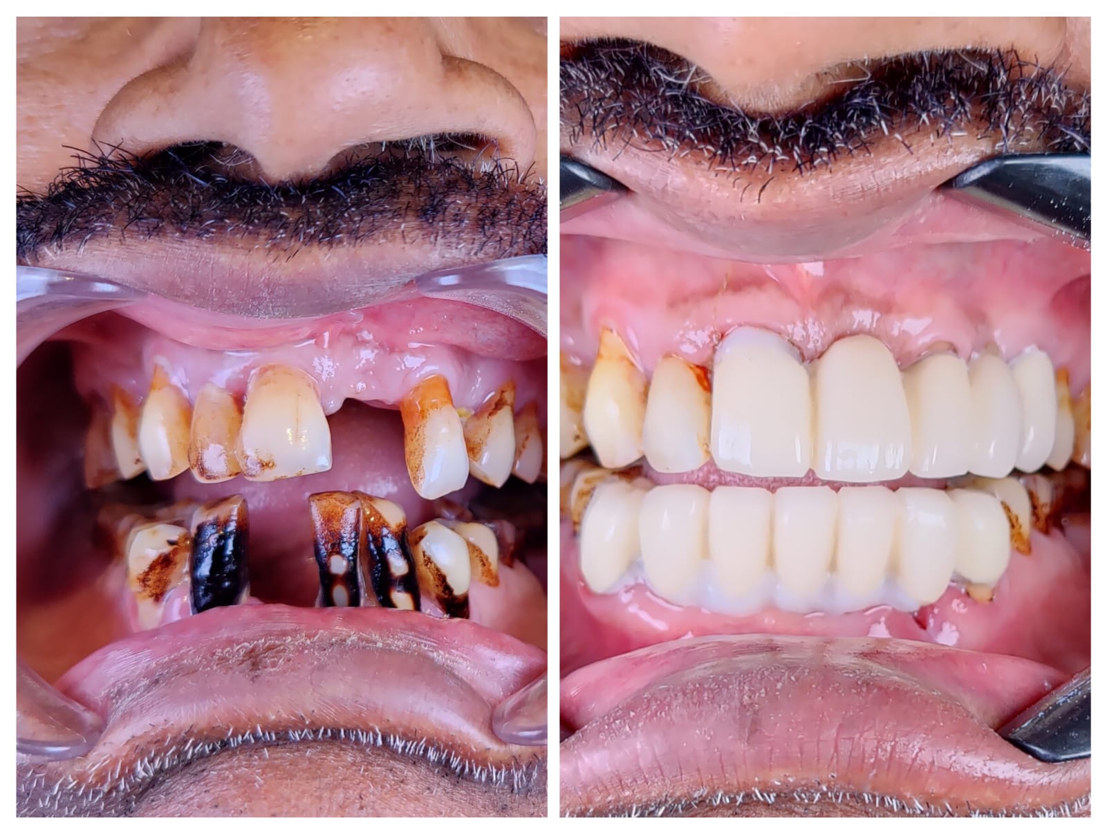 PFM bridge before and after multiple missing anterior teeth
