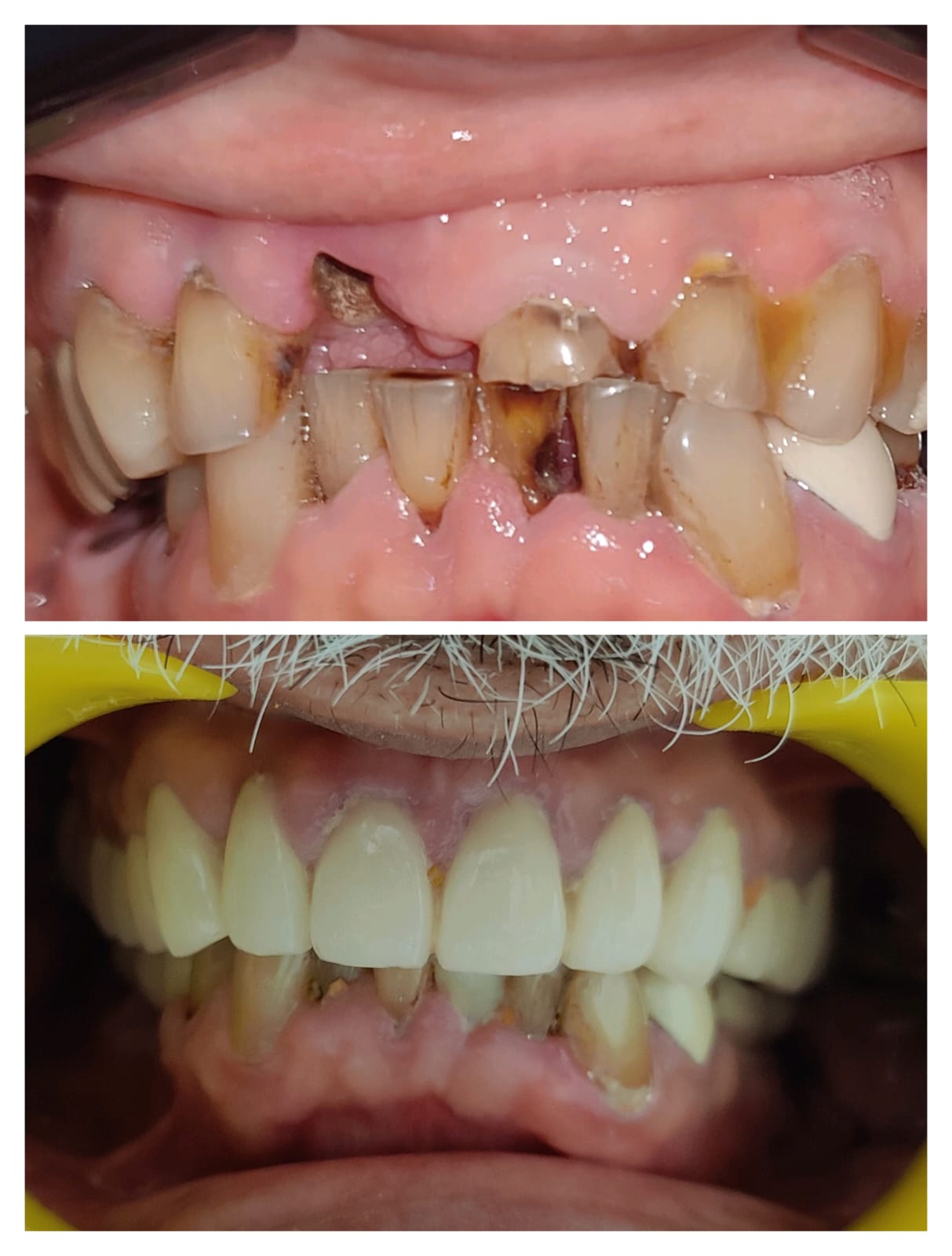 Full arch PFM crown rehabilitation before and after