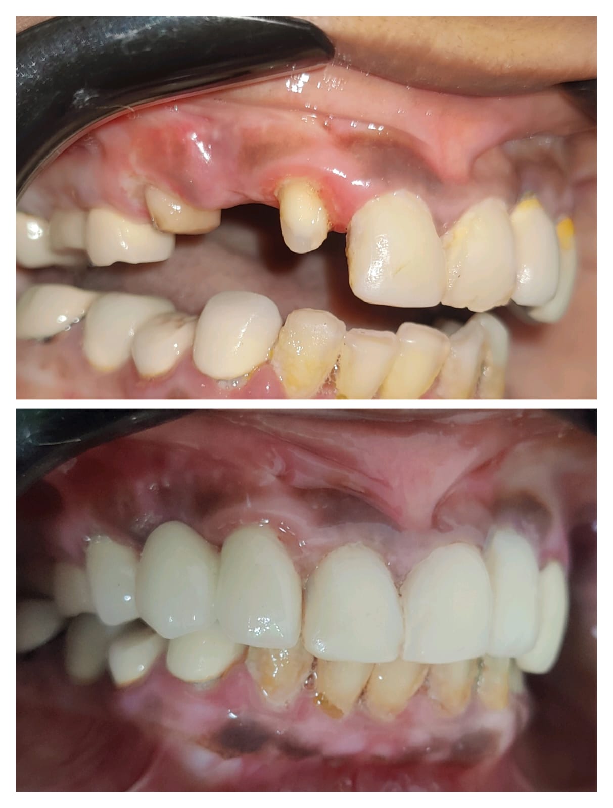 Complex PFM crown case multiple units