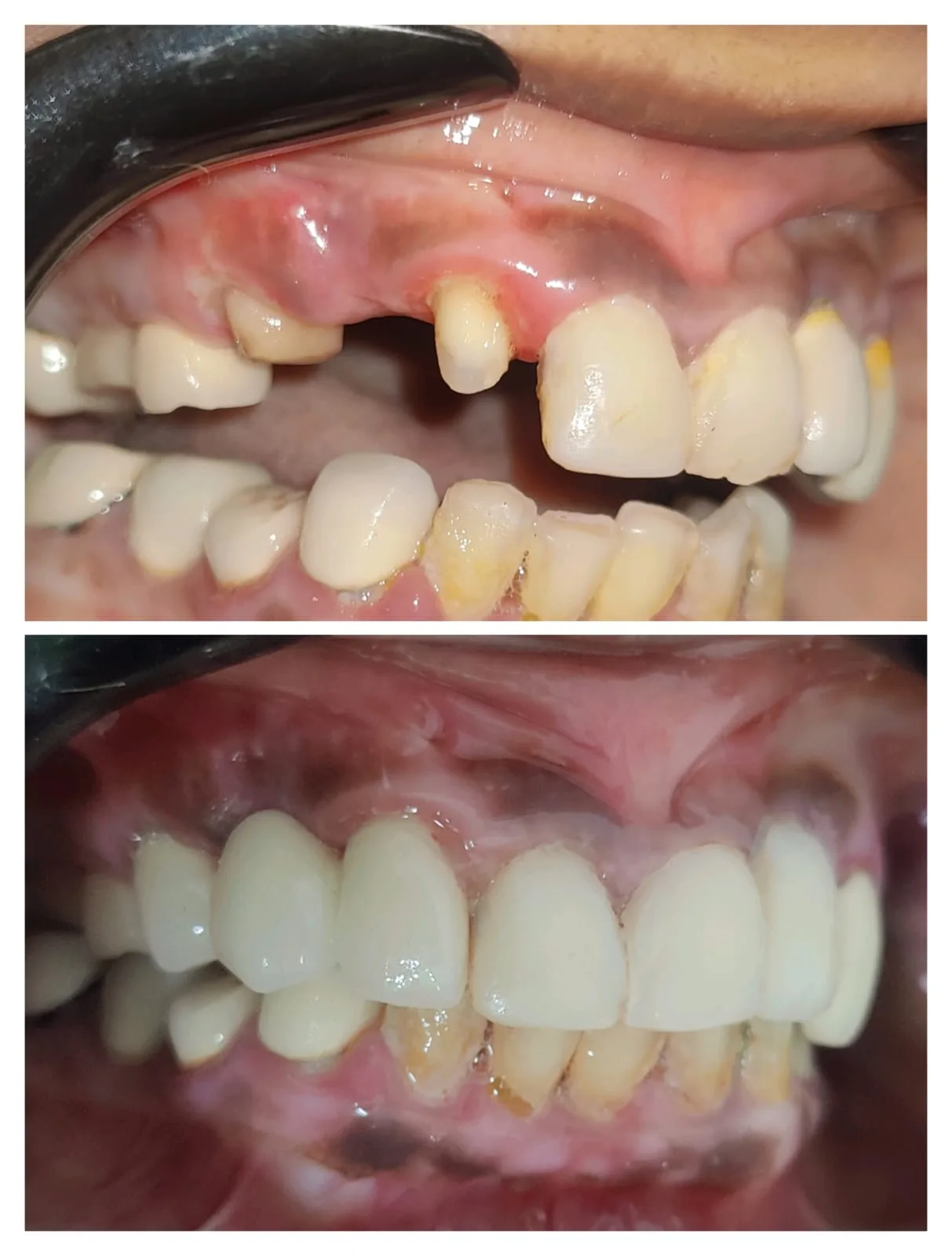 Complex PFM crown case multiple units