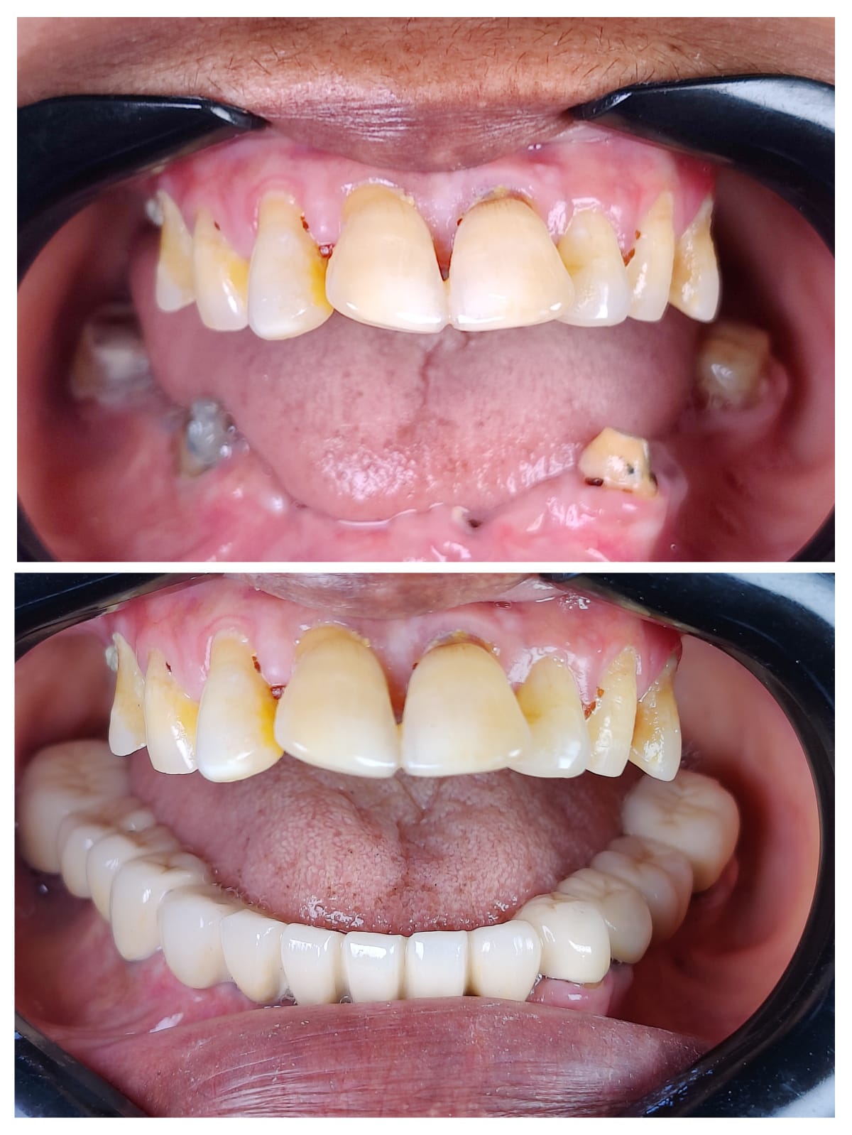 Full arch zirconia rehabilitation upper and lower