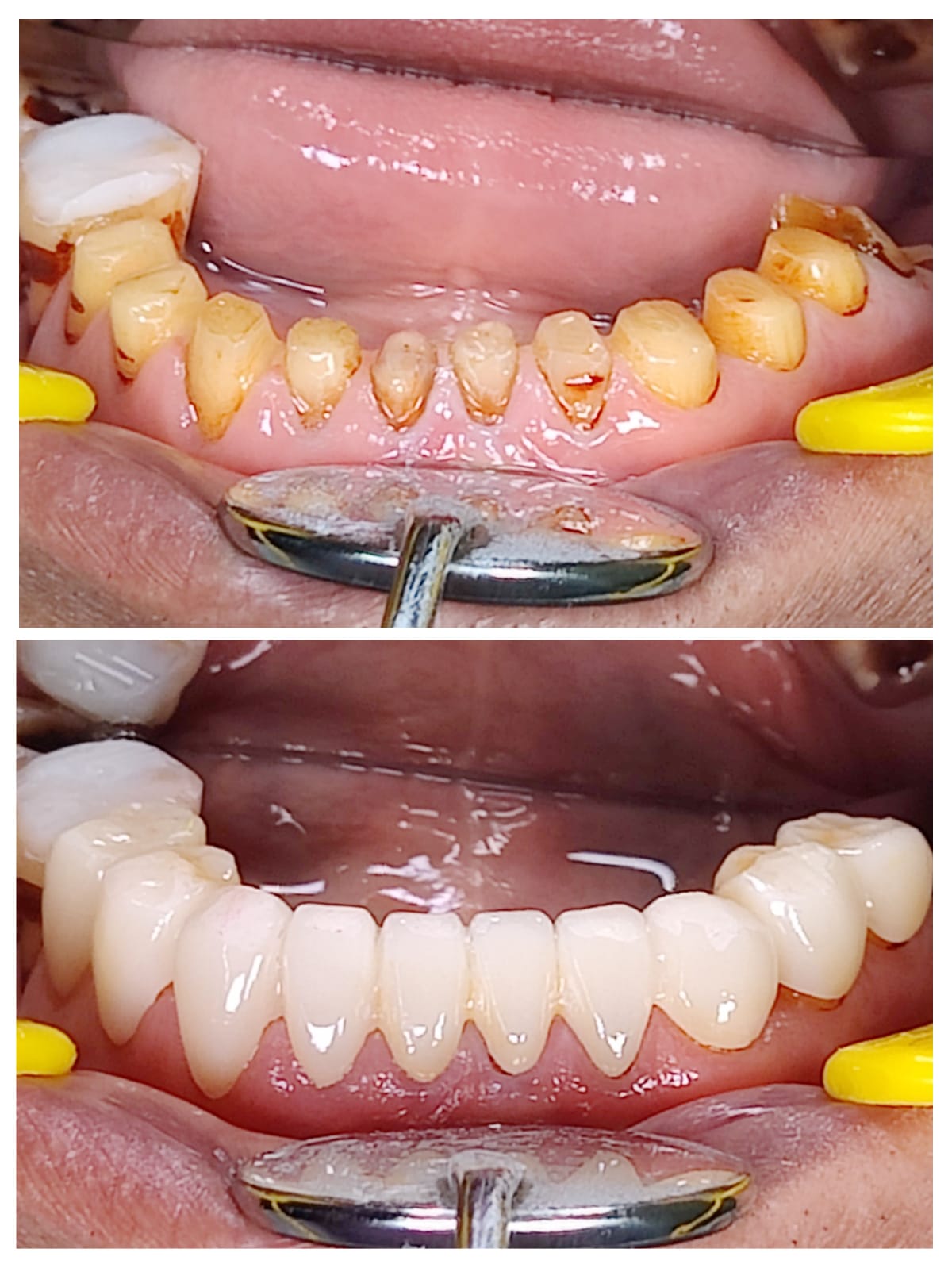 Lower anterior zirconia crowns closeup before and after