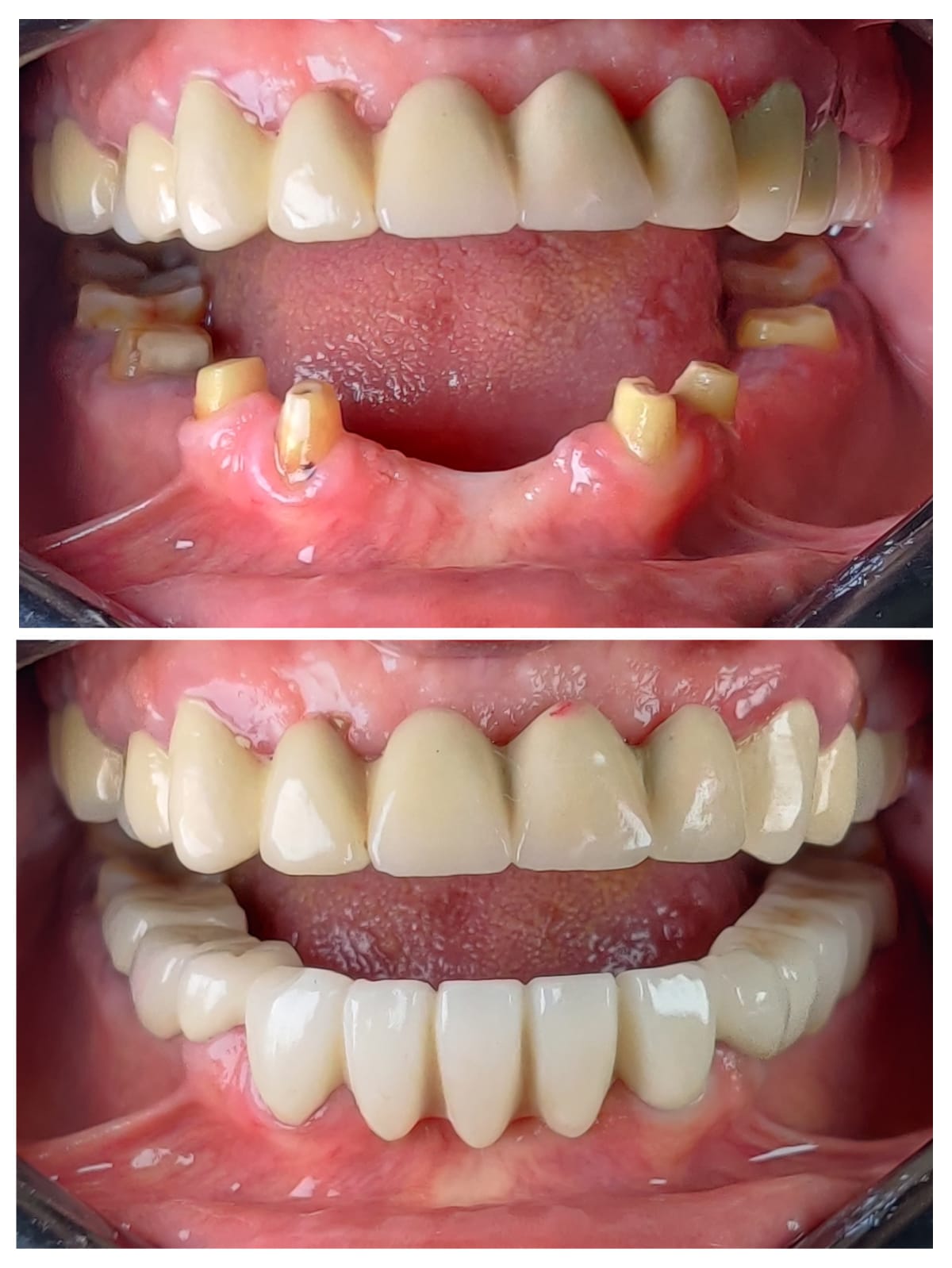 Full lower arch zirconia crown rehabilitation before and after