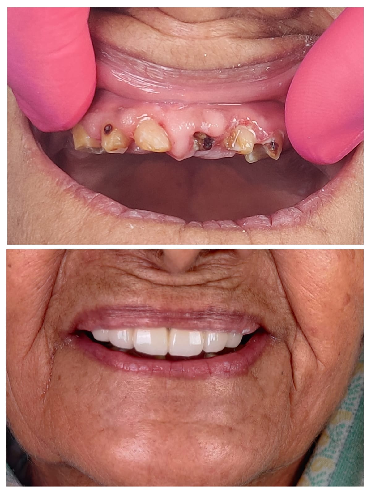 Full upper anterior zirconia reconstruction before and after