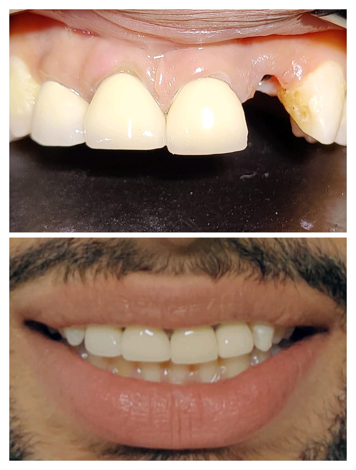 Single anterior dental implant before and after