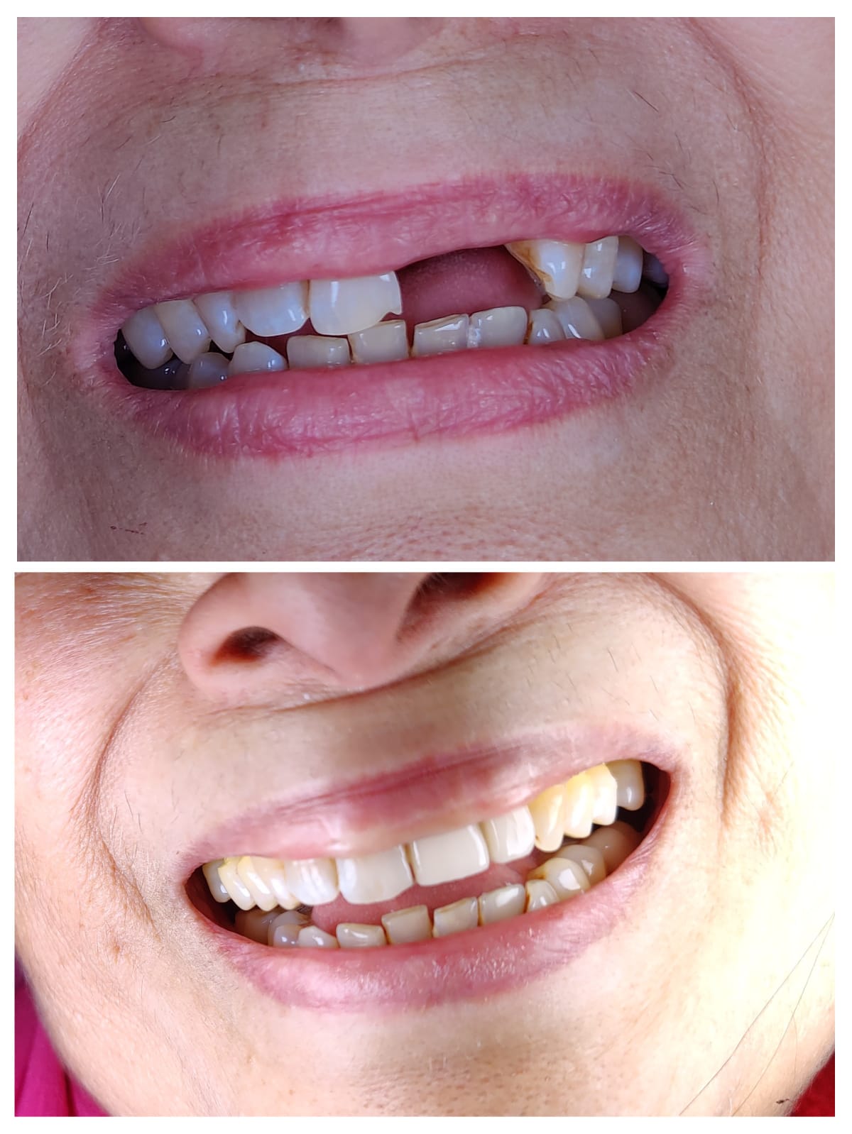 Patient smiling after anterior dental implant
