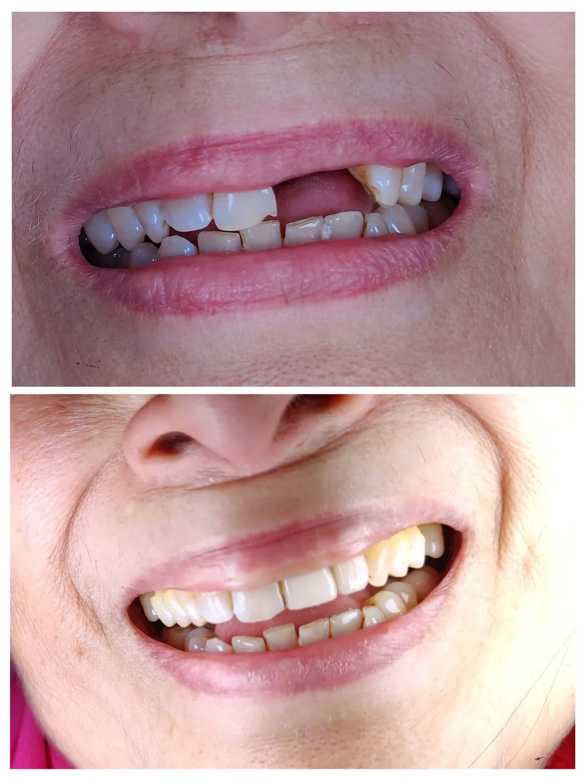 Patient smiling after anterior dental implant