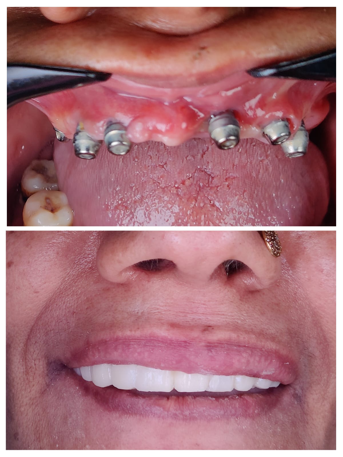 Full arch implant rehabilitation before and after