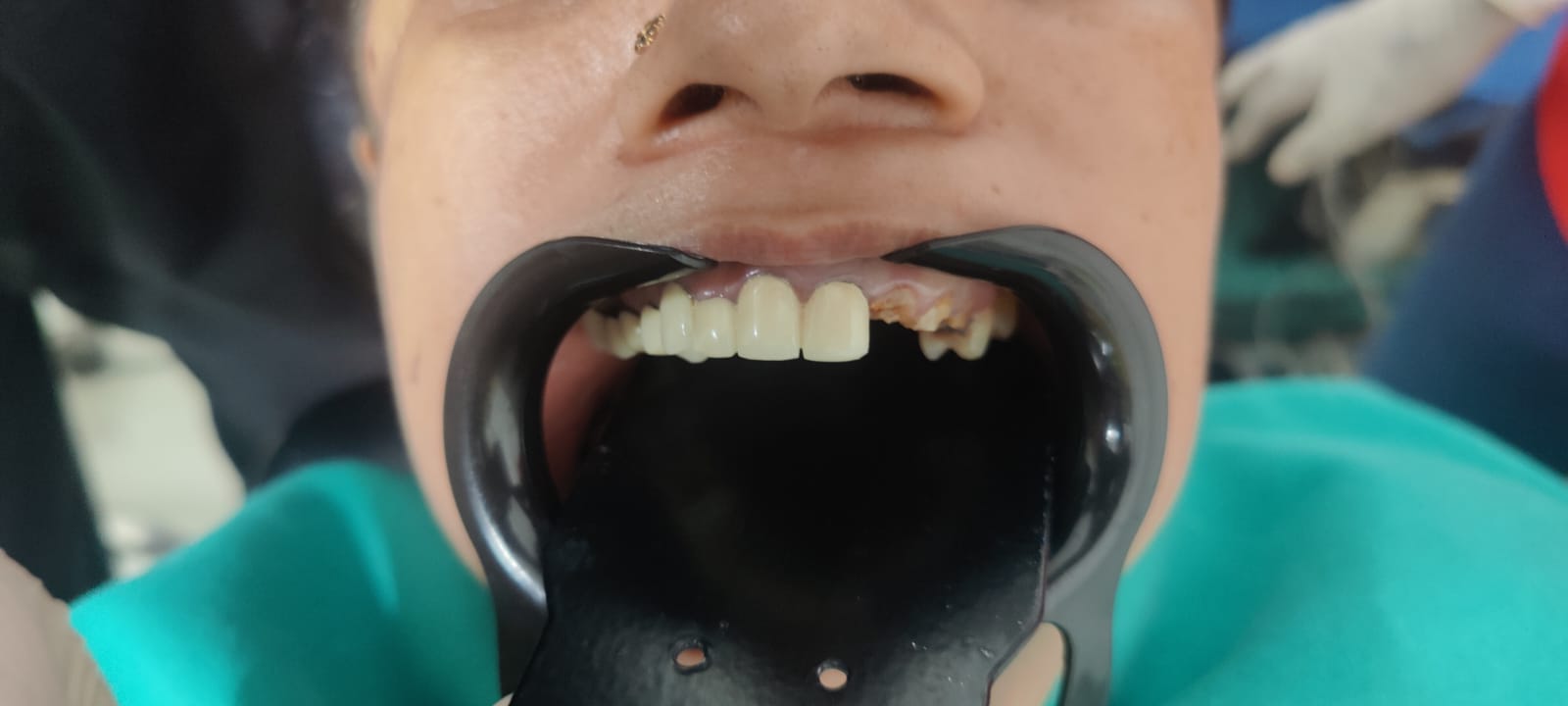 Immediate dental implant placed same day as extraction