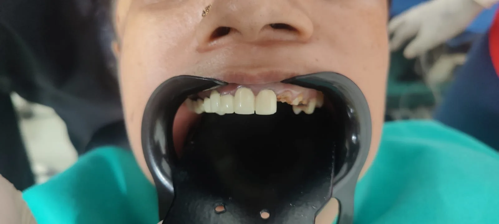 Immediate dental implant placed same day as extraction