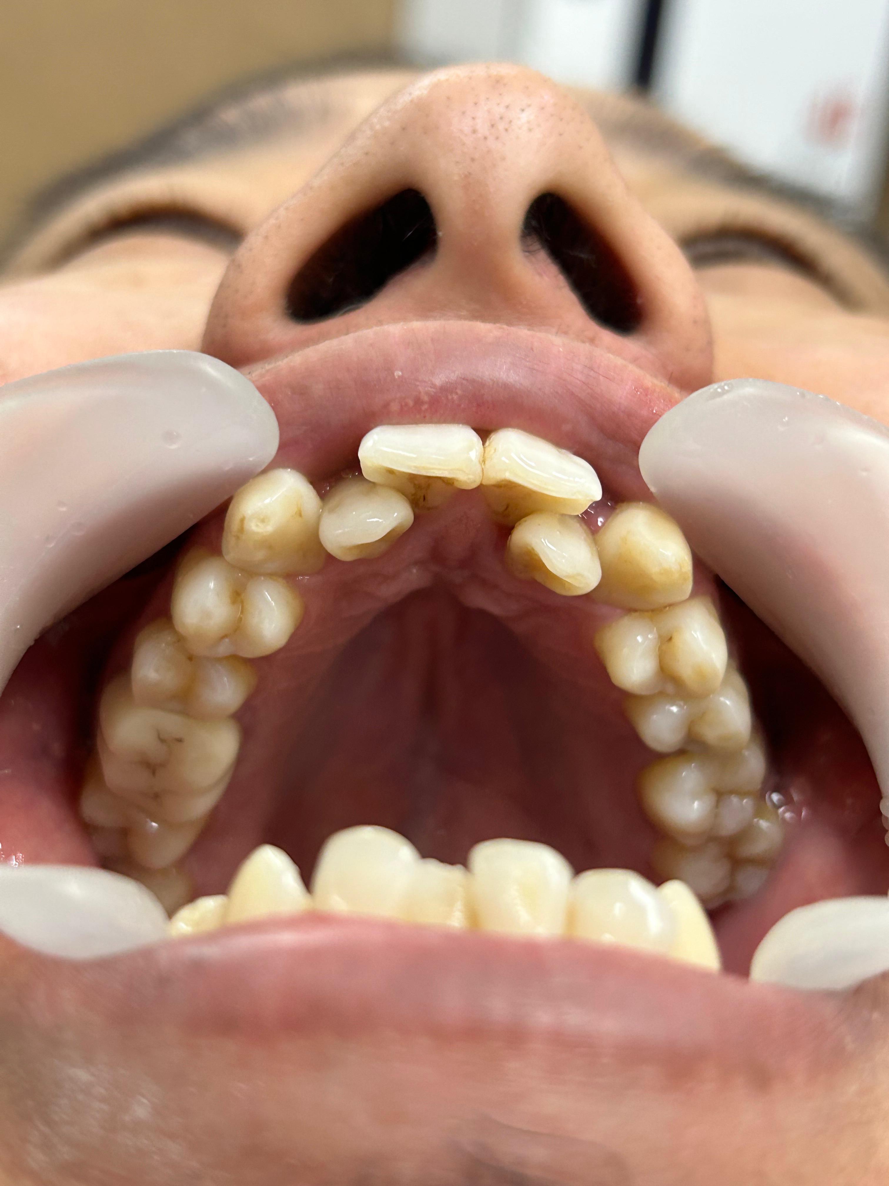 Clear aligner case before and after by Dr Aman