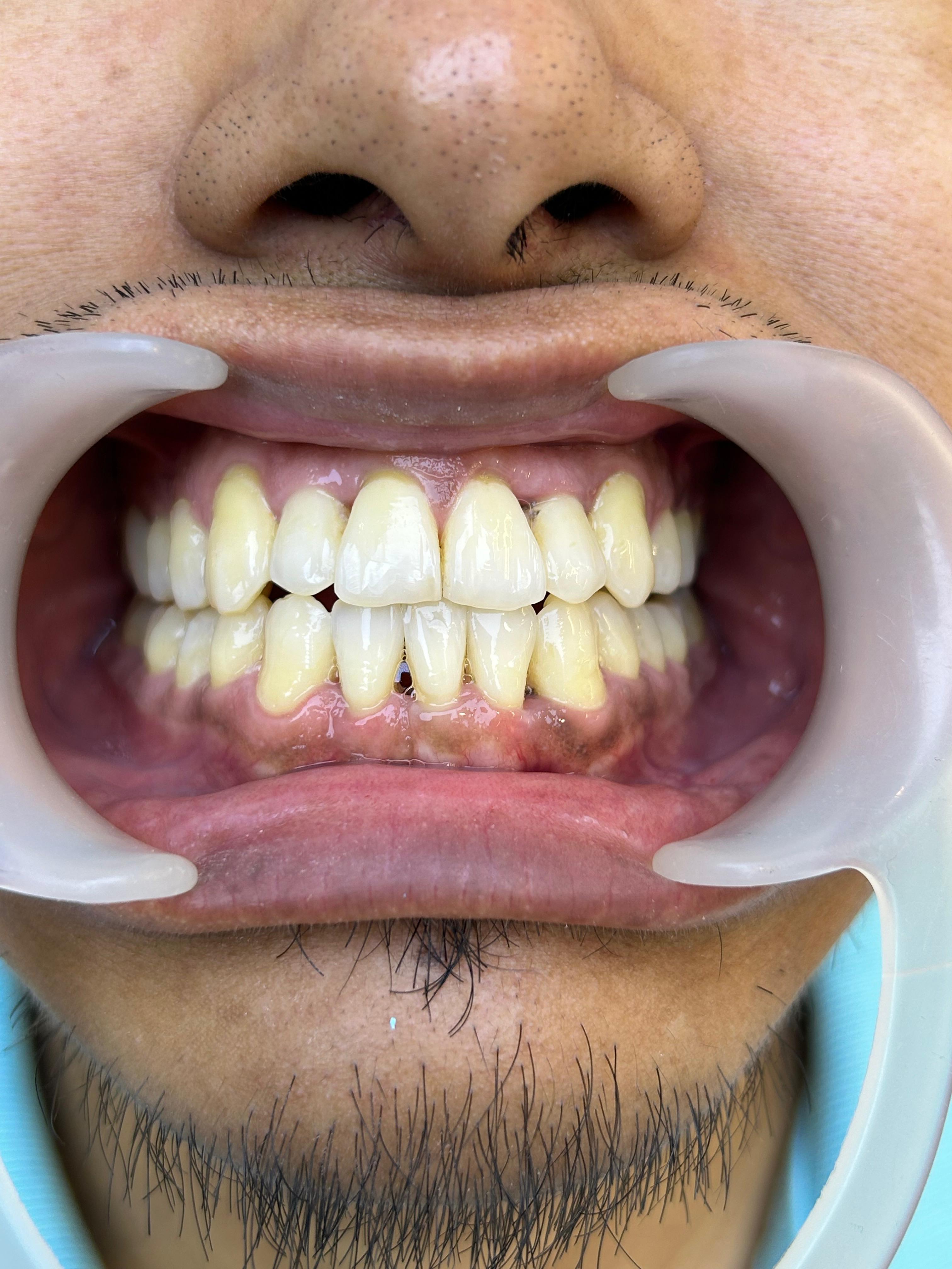 Clear aligner lateral view case