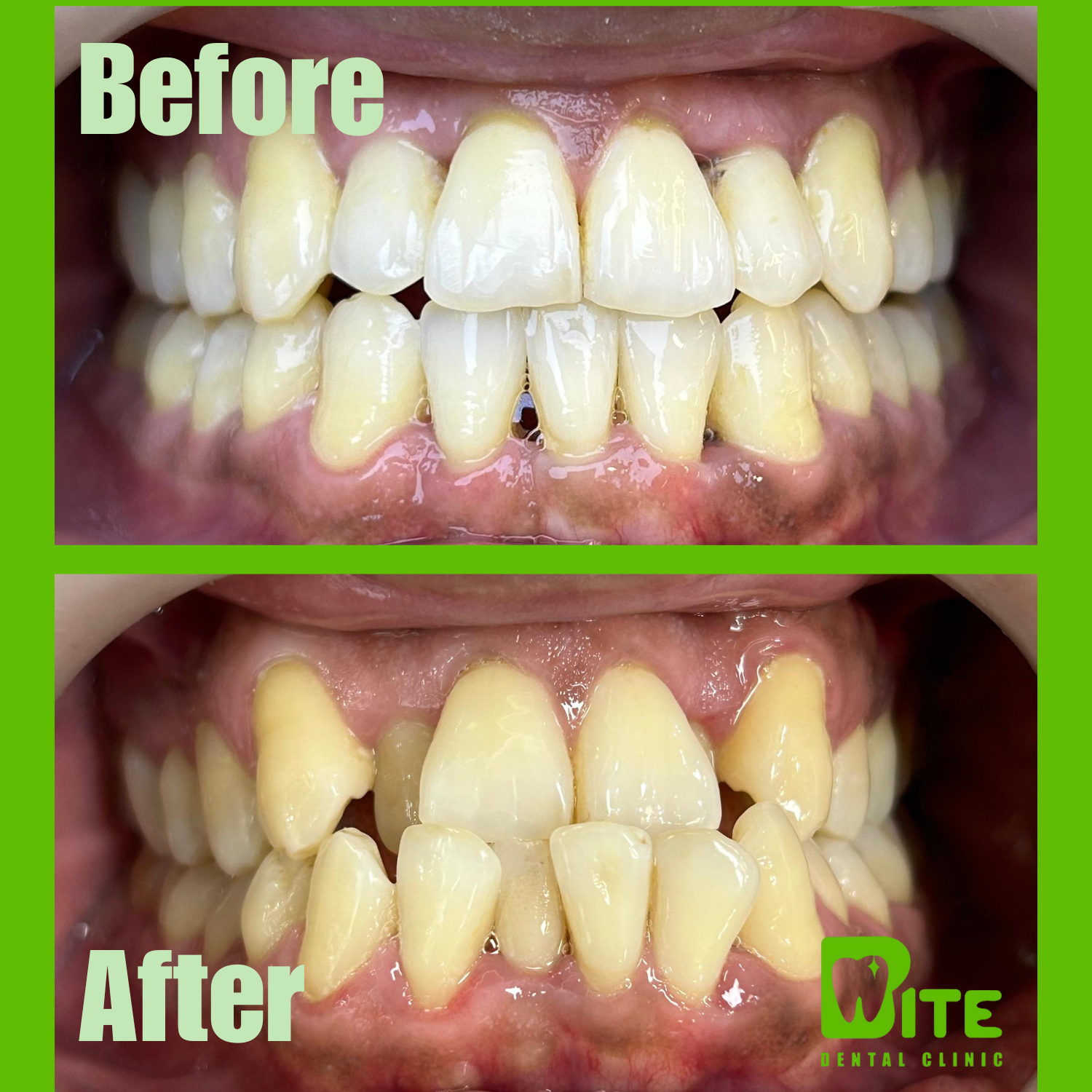 Braces frontal result before and after
