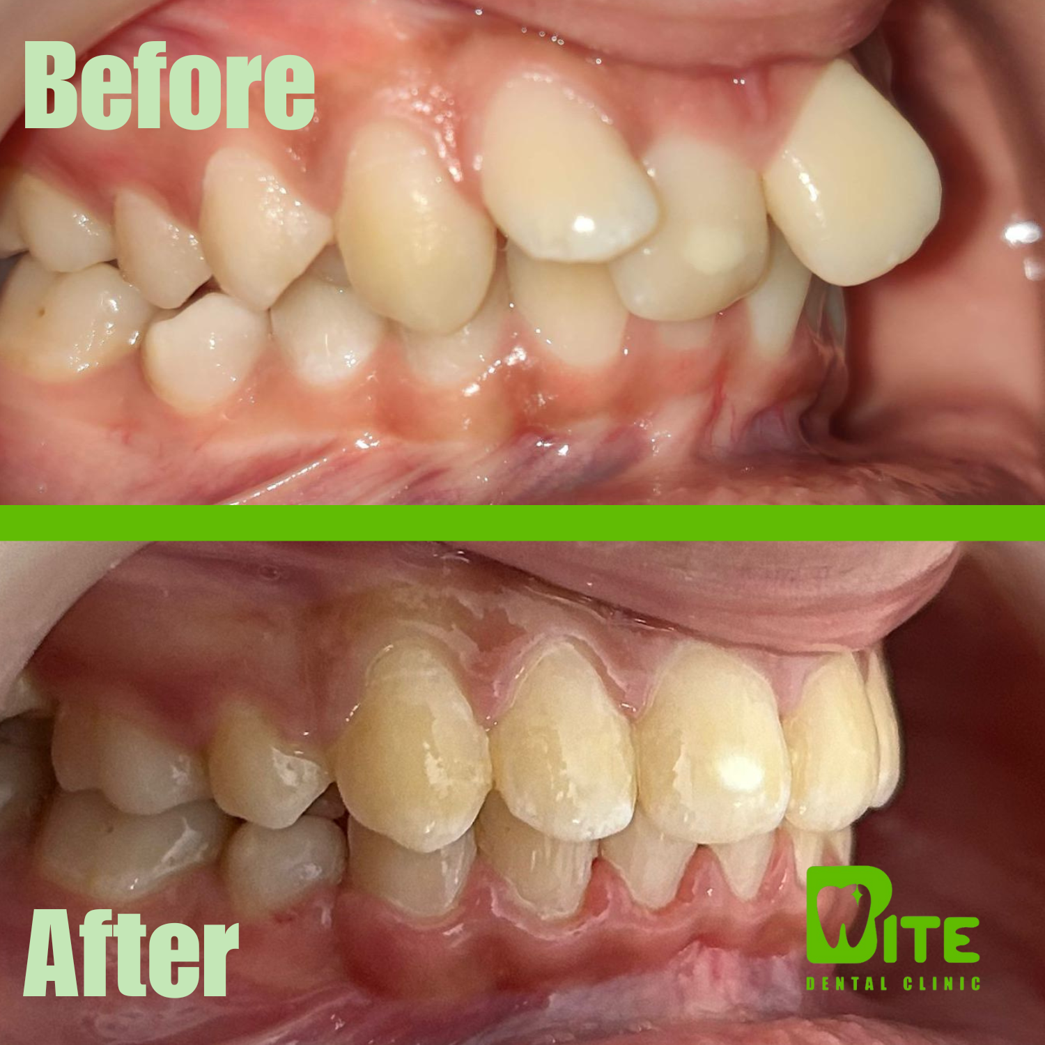 Braces lateral occlusion before and after
