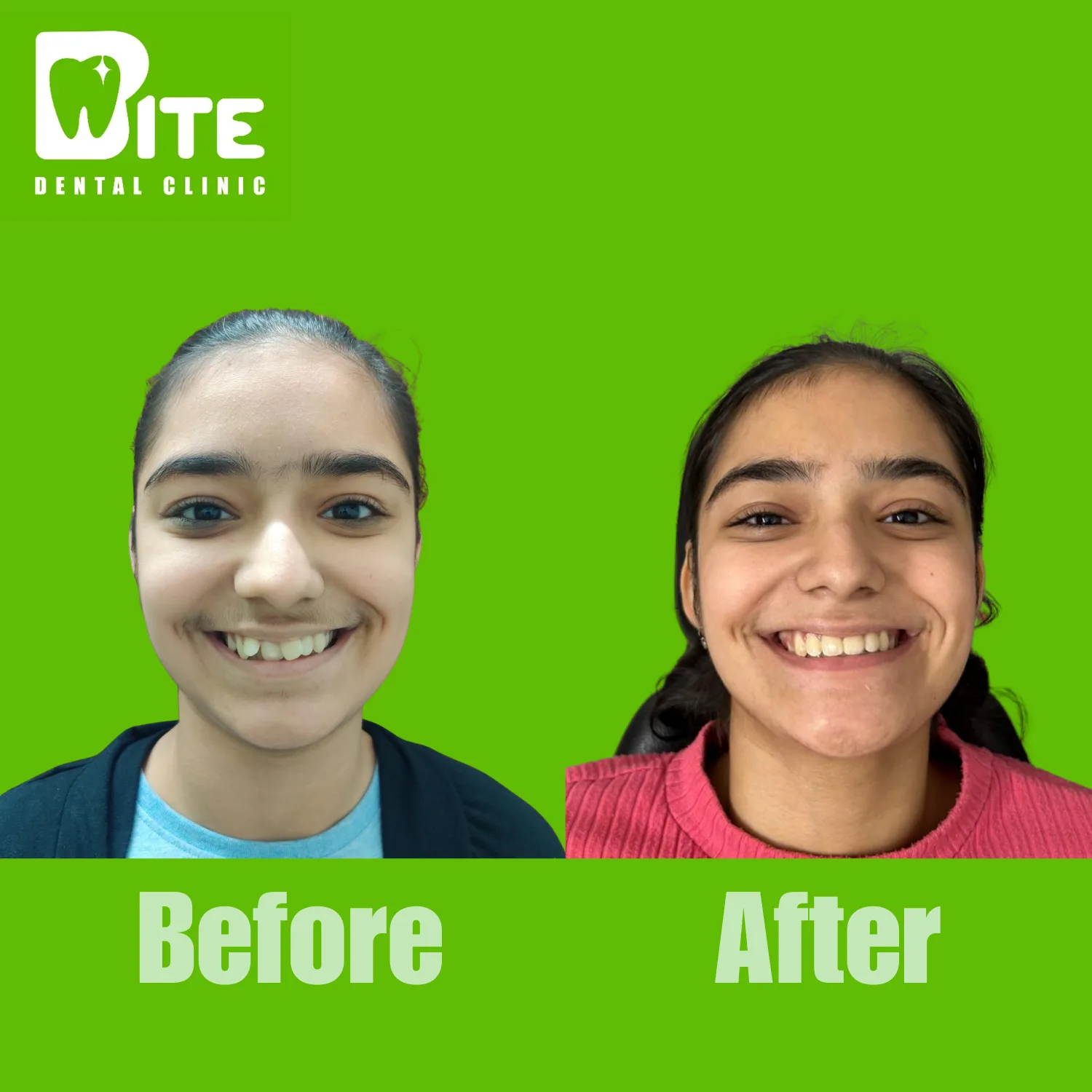 Before and after clear aligner treatment – full face smile transformation at Bite Dental Clinic
