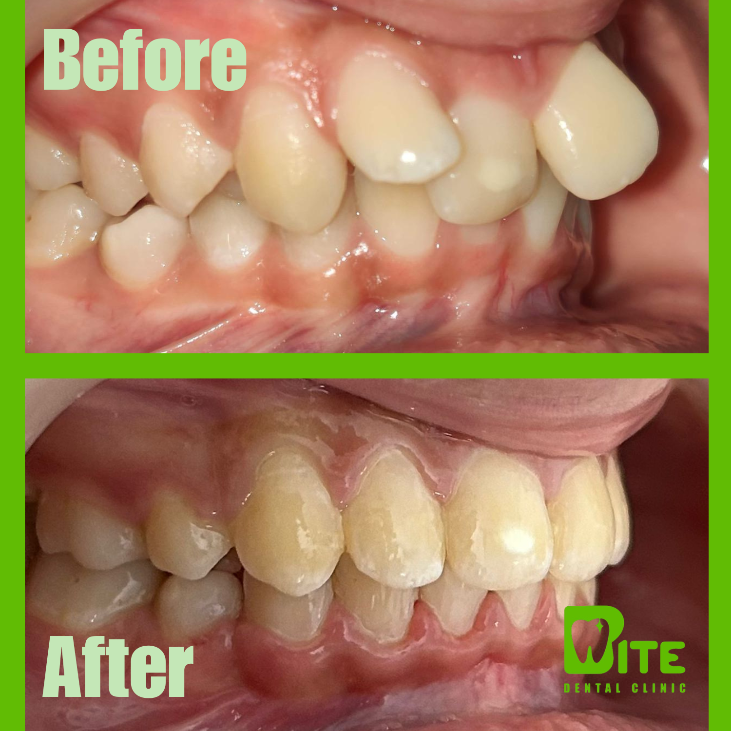 Before and after clear aligner treatment – severe overjet and bite corrected at Bite Dental