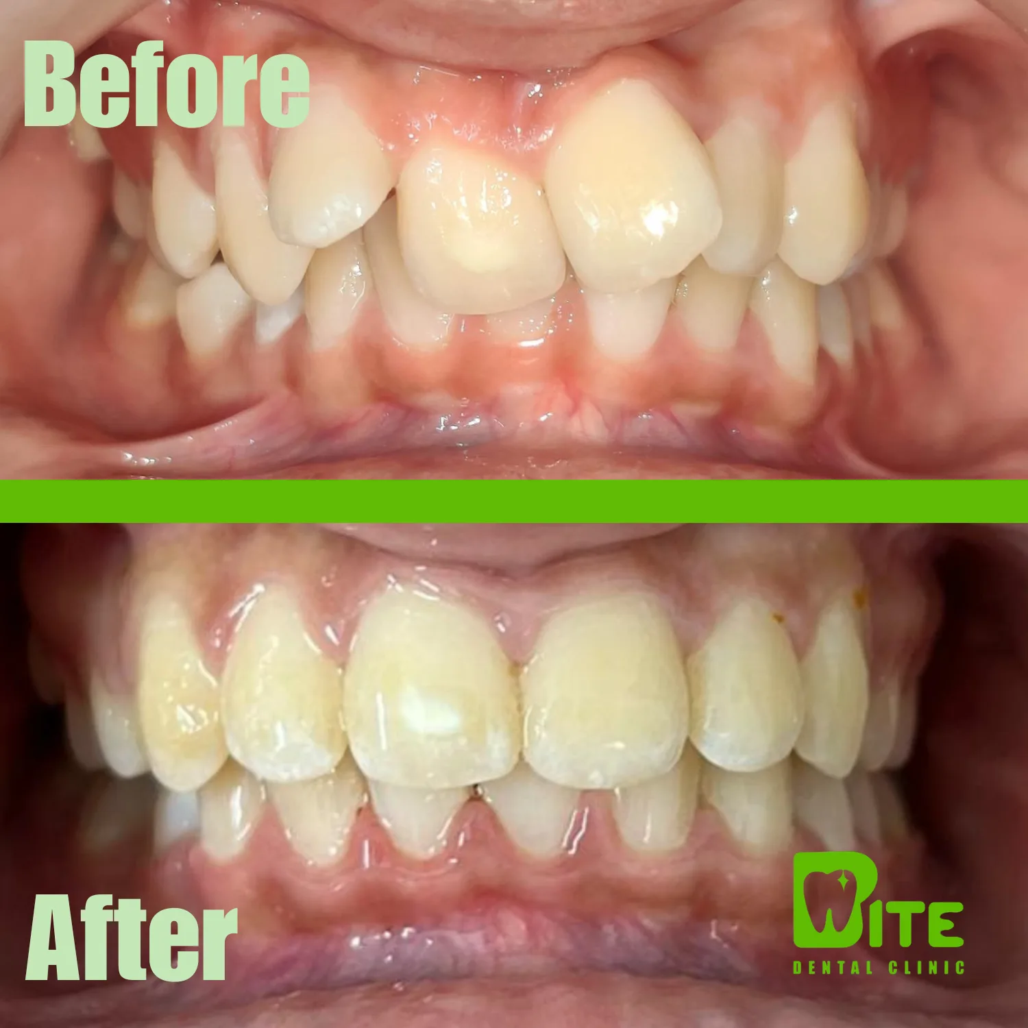 Before and after clear aligner treatment – crowded upper teeth corrected at Bite Dental