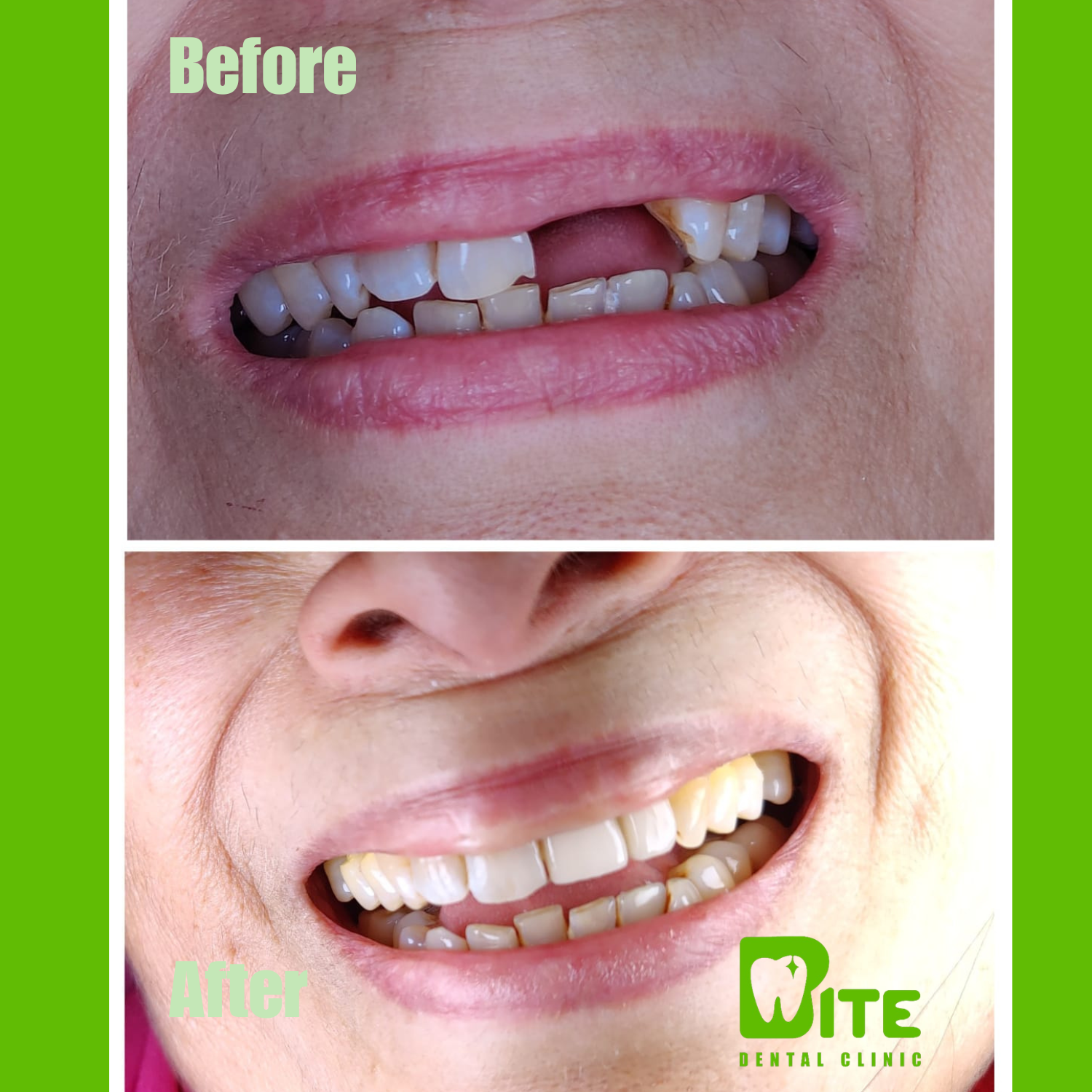 Before and after dental implants – broken and missing front teeth restored at Bite Dental