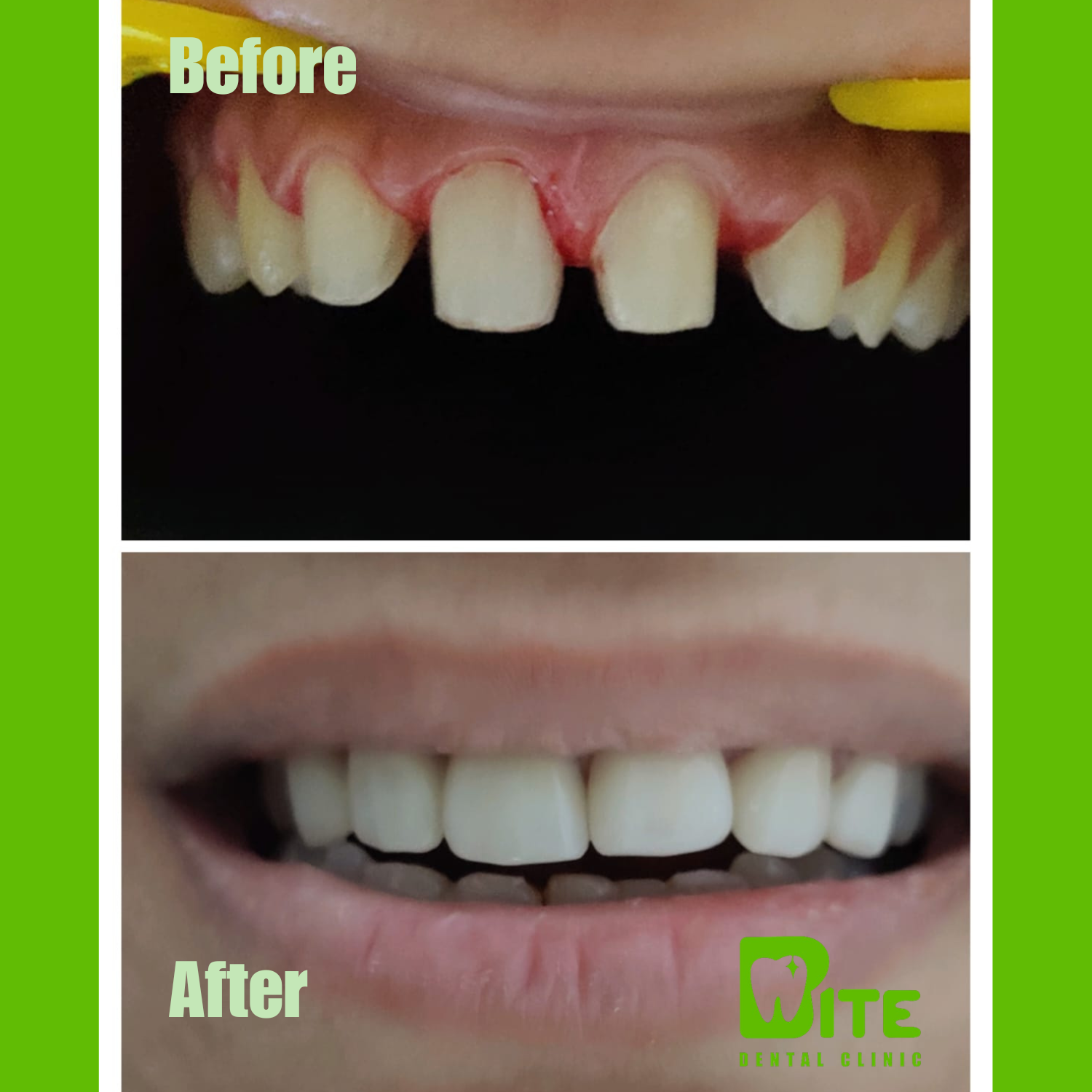Before and after porcelain veneers – severely worn and discoloured teeth transformed at Bite Dental