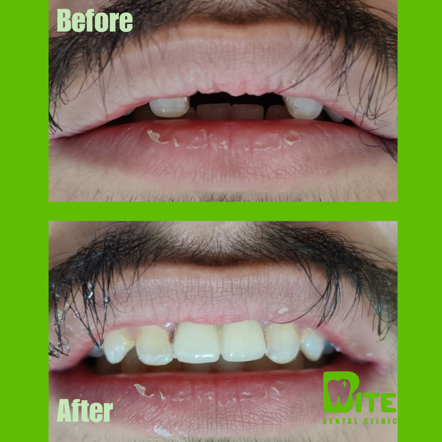 Before and after multiple dental implants – missing upper teeth fully restored at Bite Dental