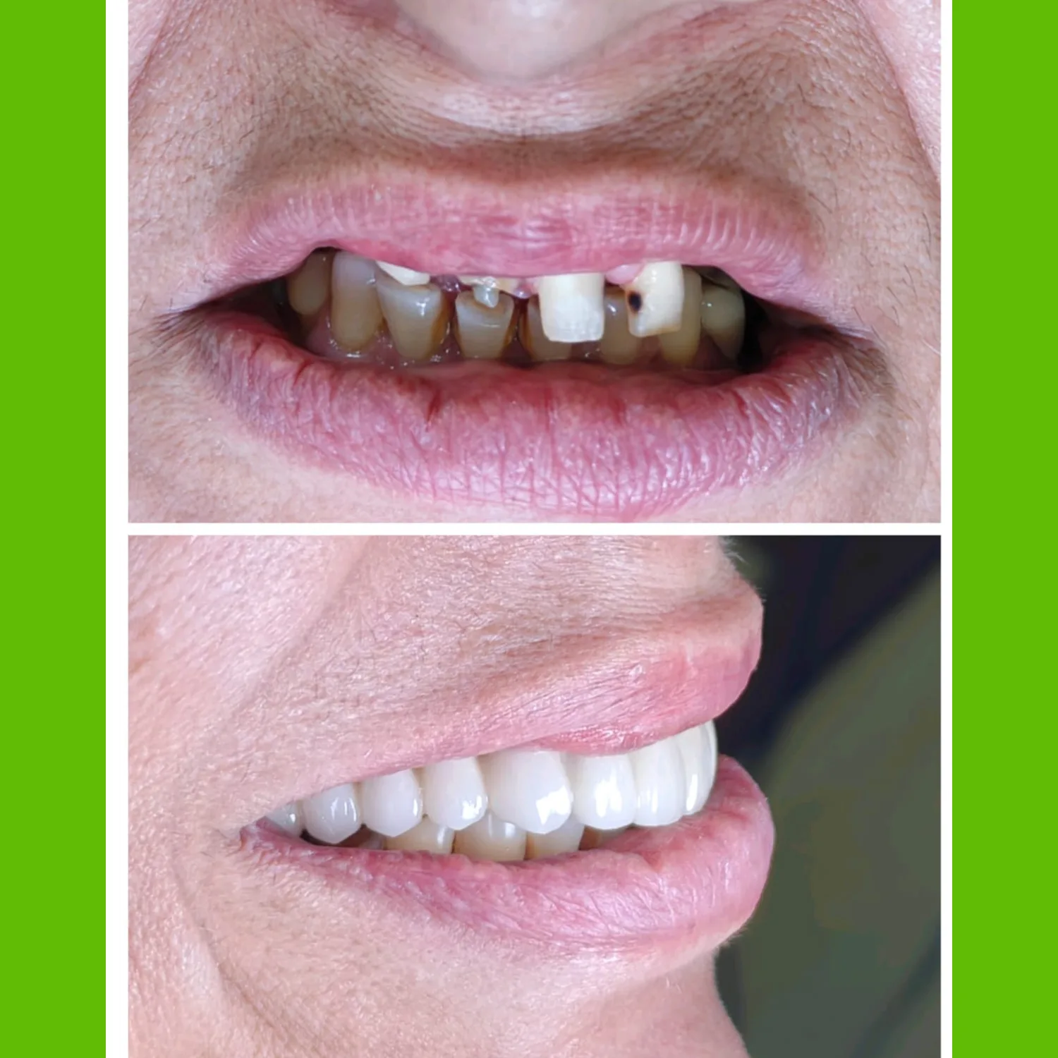 Before and after full mouth restoration – severely damaged teeth rebuilt at Bite Dental Clinic