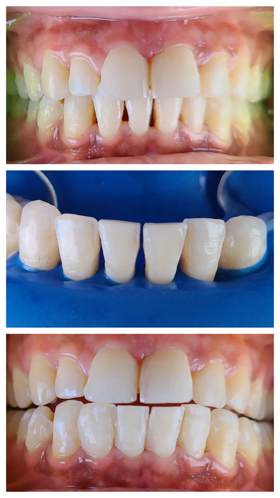 Diastema closure with laminates - process and result