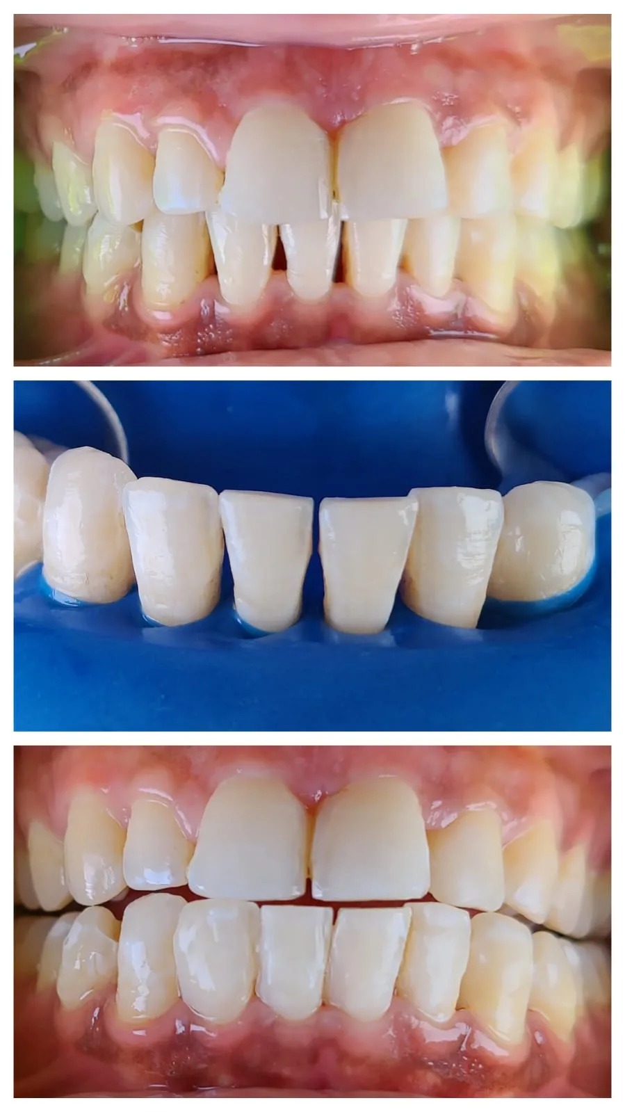 Diastema closure with laminates - process and result