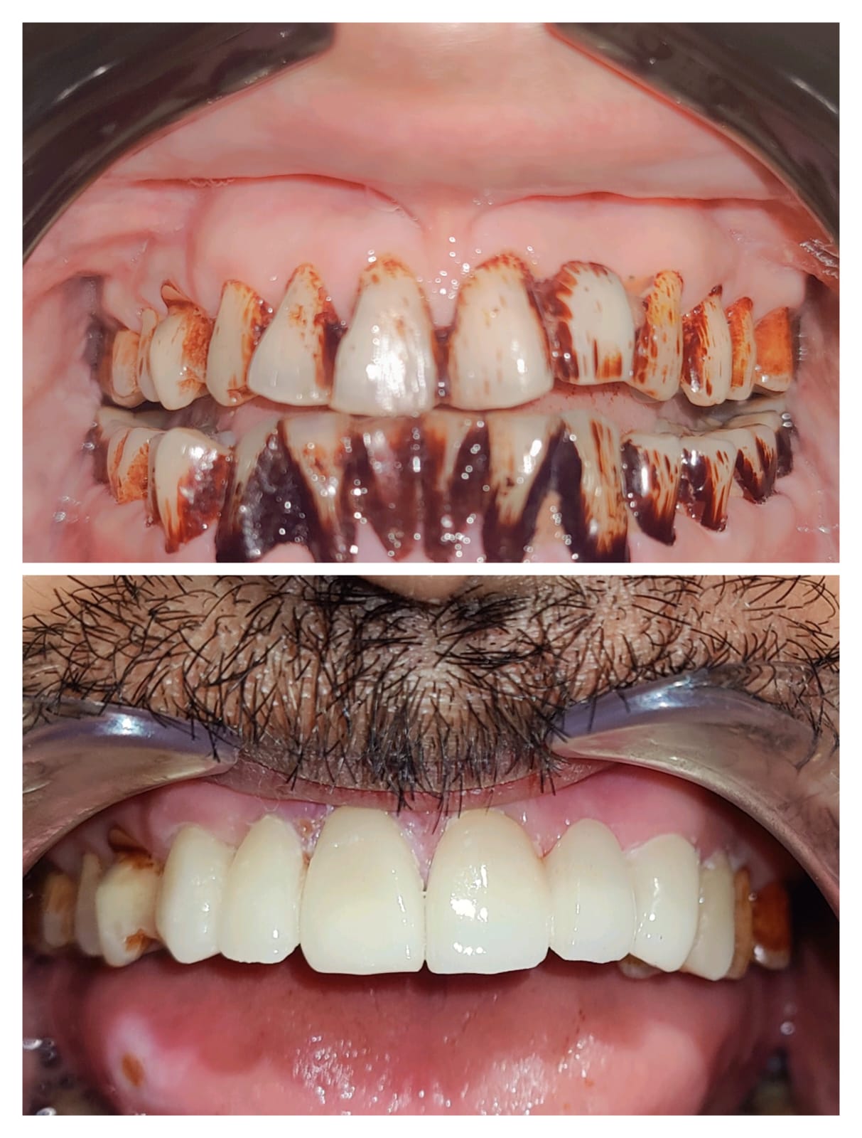 Porcelain laminates full smile transformation - before and after
