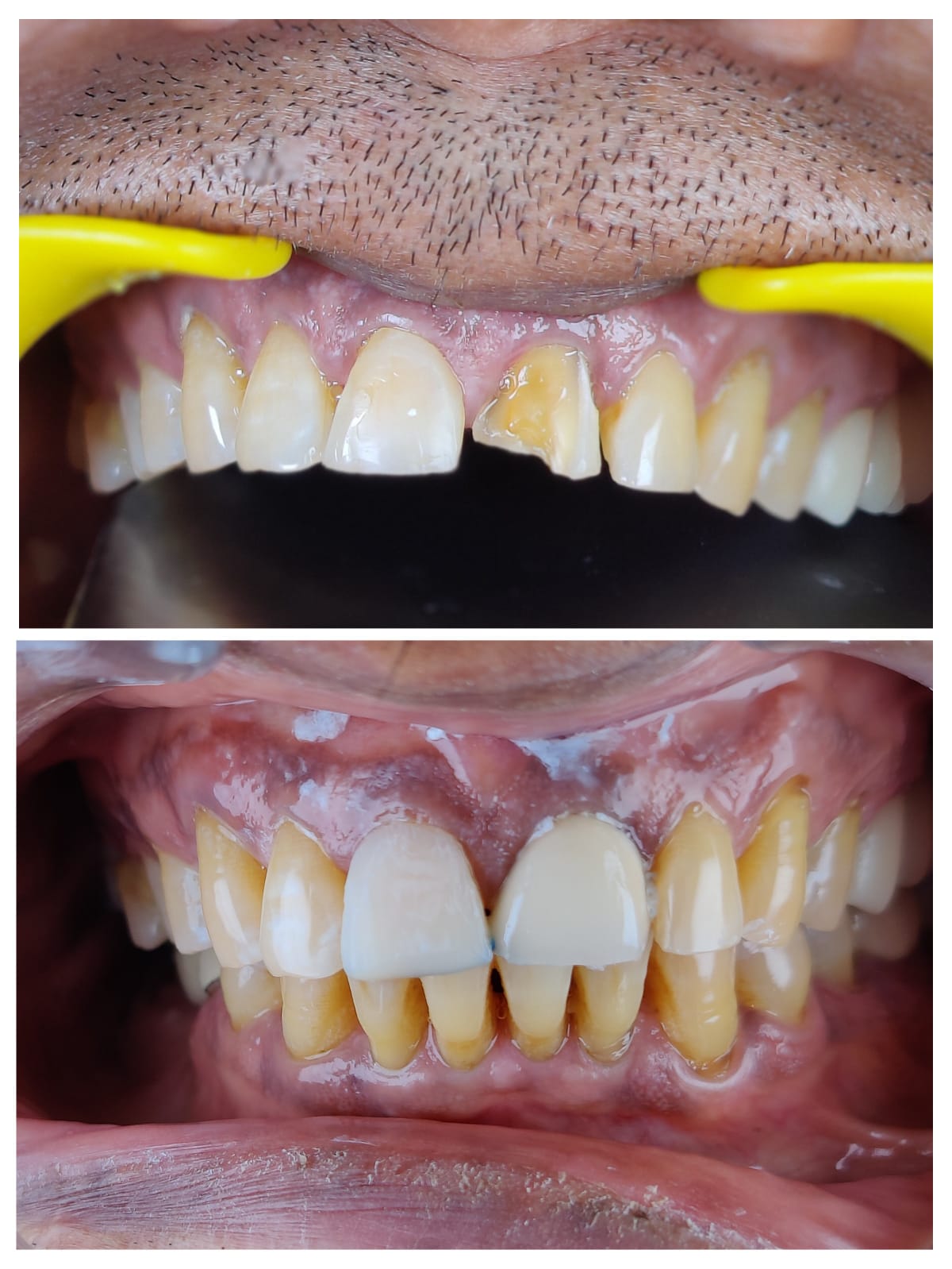 Single tooth veneer result