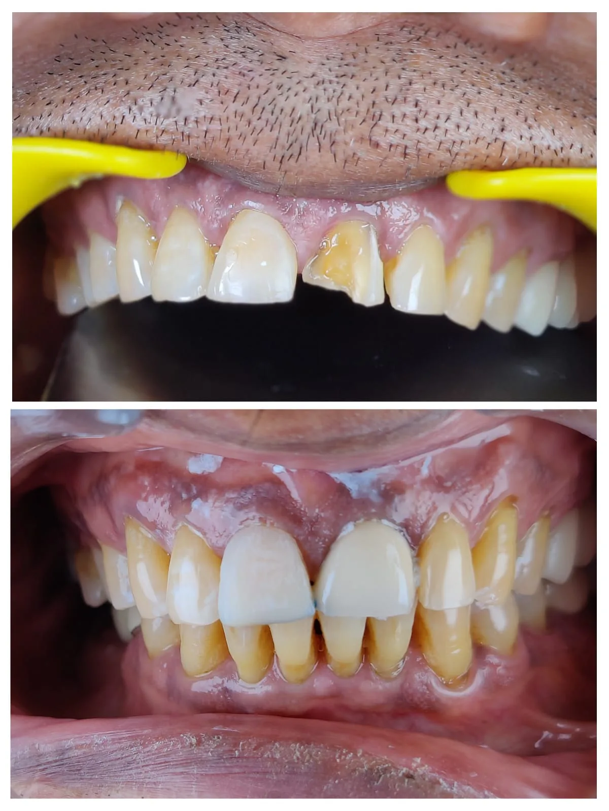 Single tooth veneer result