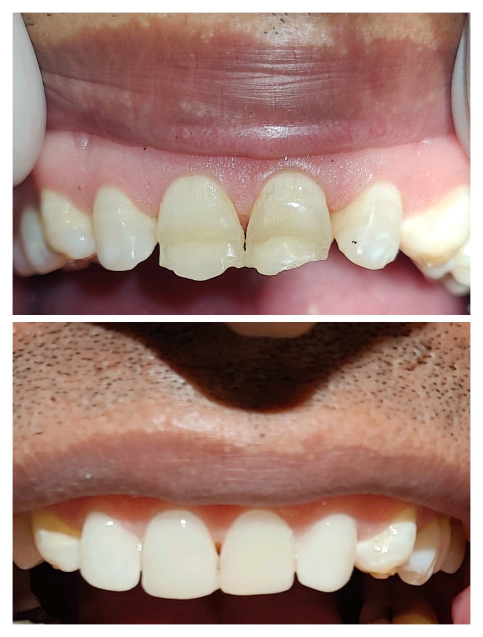 Midline diastema fixed with veneers - before and after