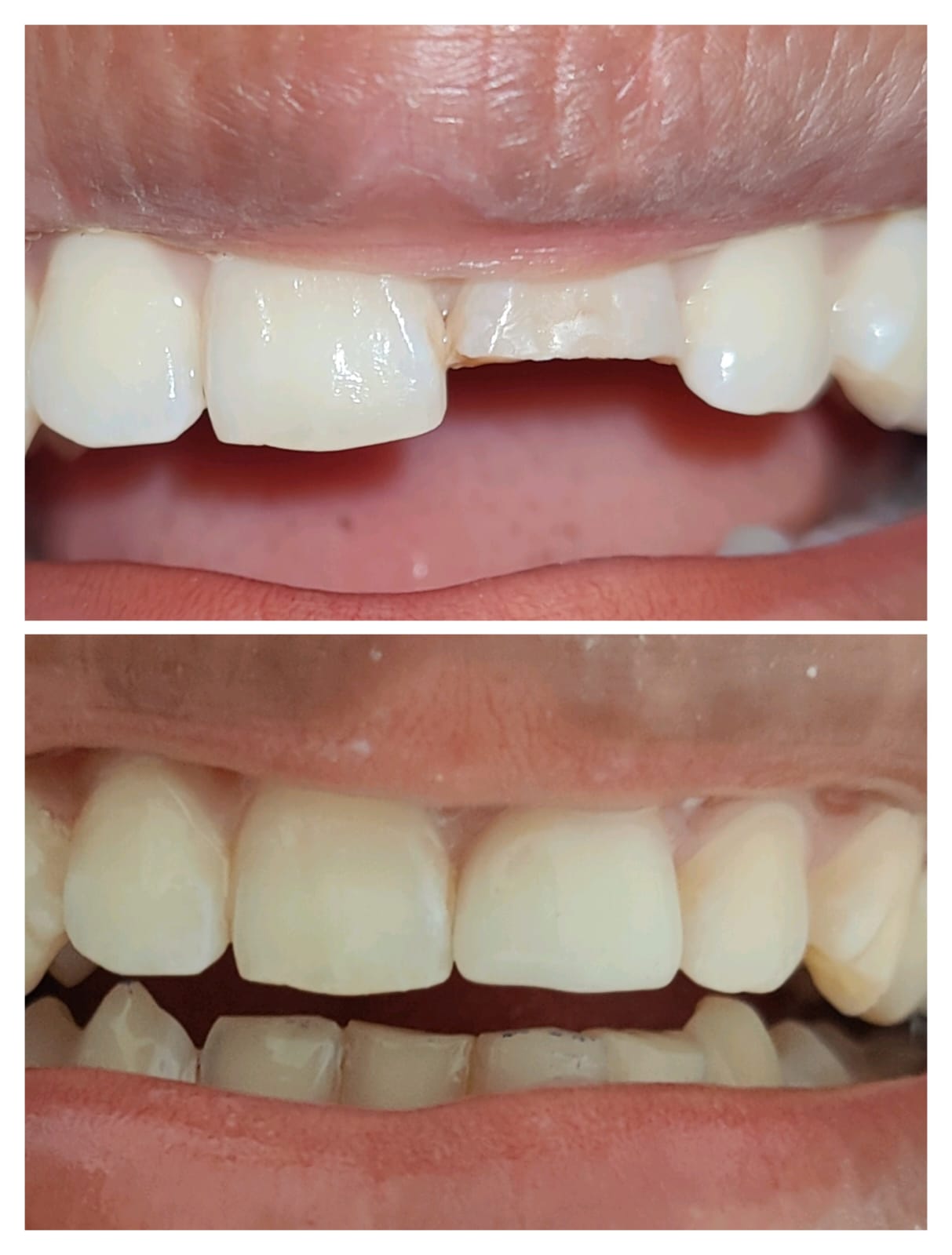 Smile design case result at Bite Dental