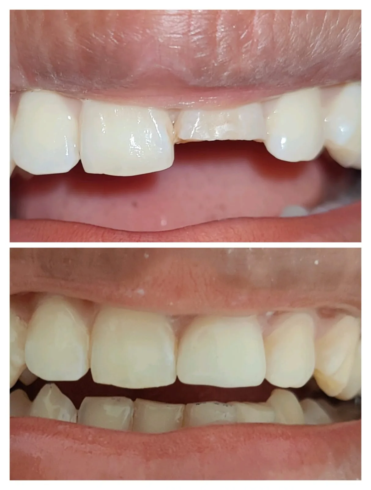 Smile design case result at Bite Dental