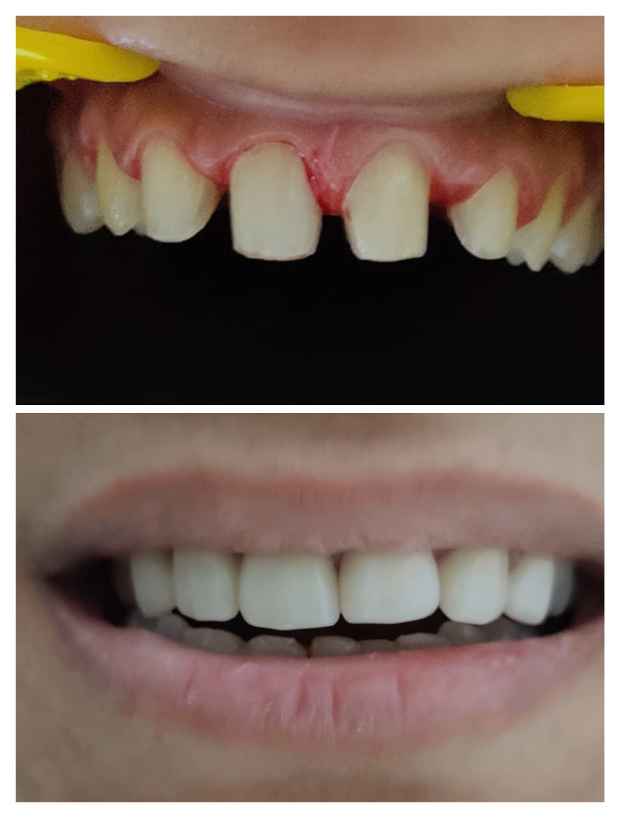 Veneers before and after smile transformation at Bite Dental Clinic