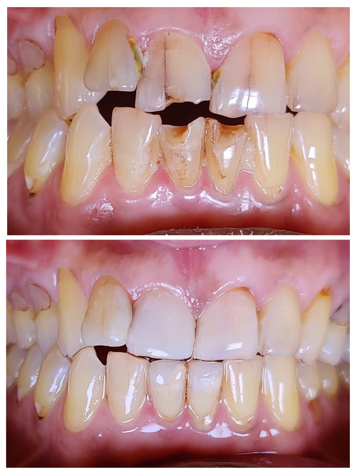 Veneers spacing correction before and after